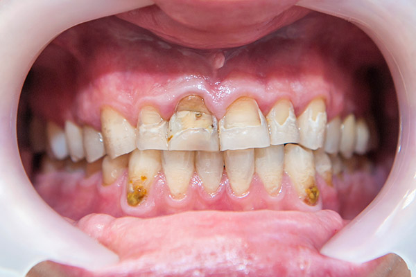 dental fluorosis example