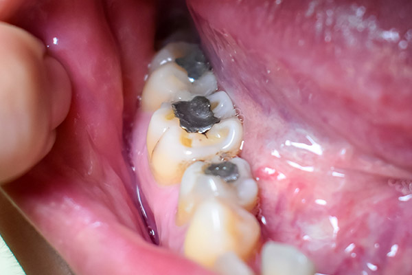 silver amalgam fillings in molars