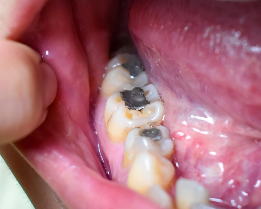 mercury amalgam fillings