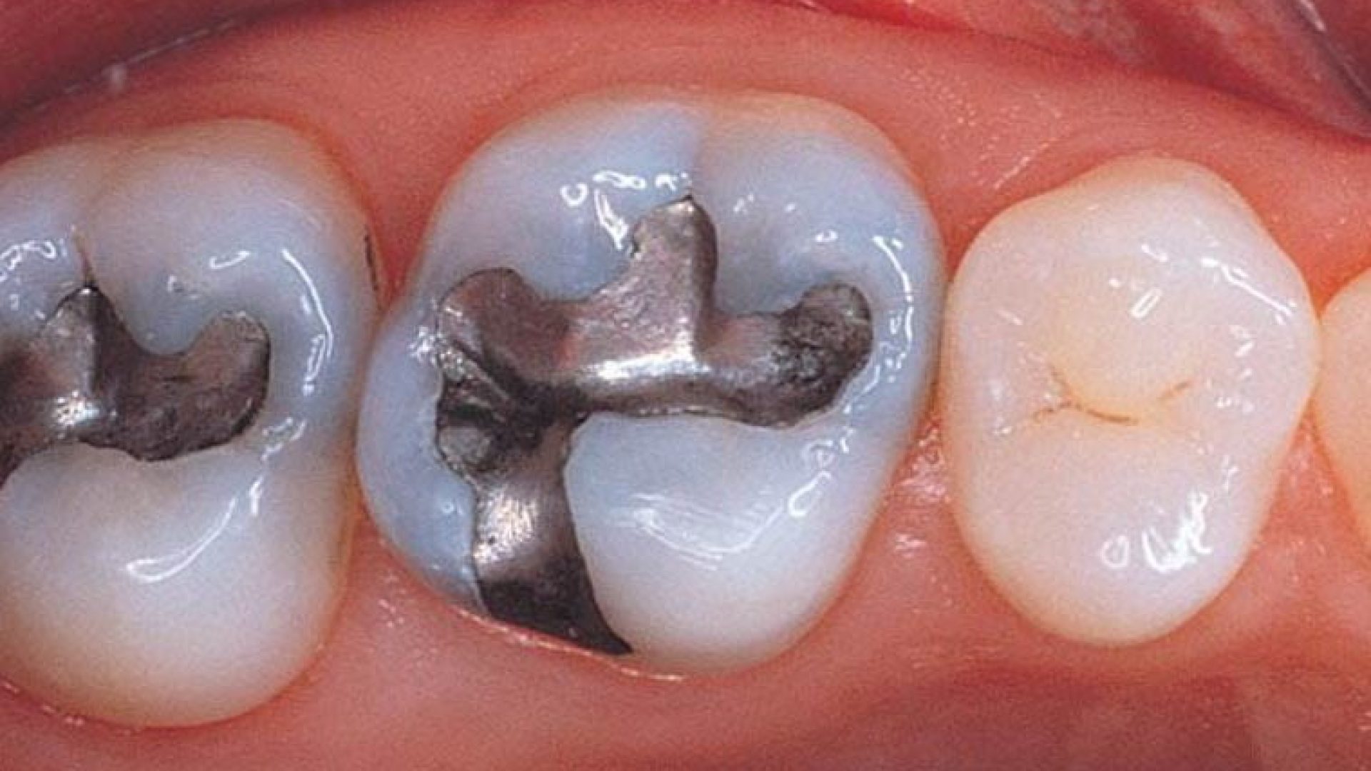 amalgam-filling2