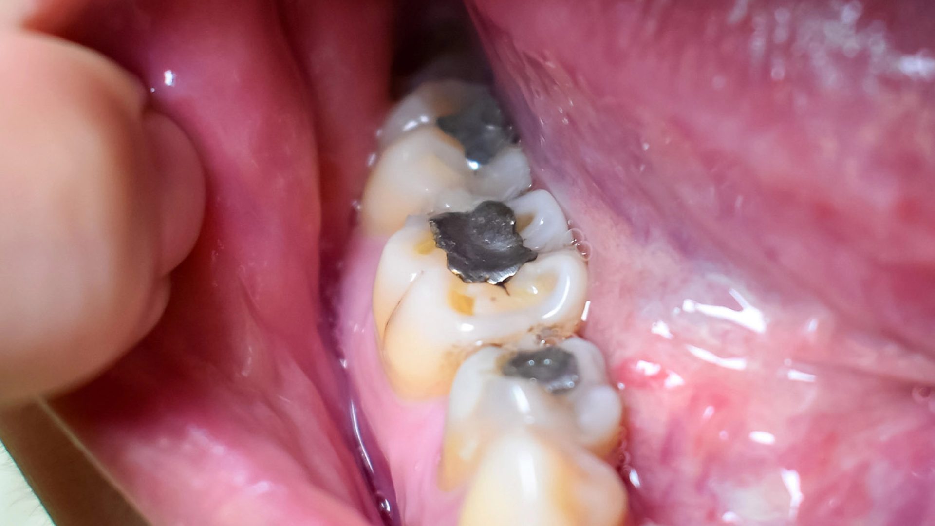 mercury amalgam fillings